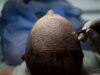 Como a Turquia invadiu a indústria de transplante capilar