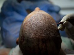 Como a Turquia invadiu a indústria de transplante capilar